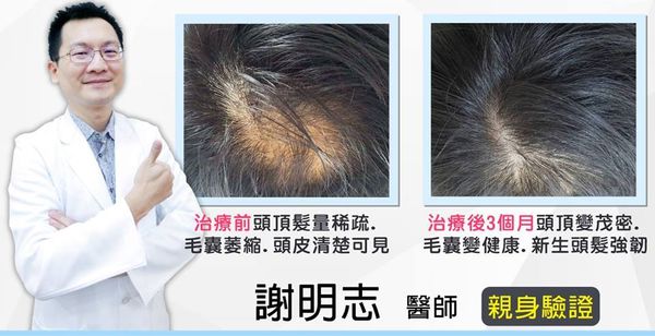 謝明志醫師對抗雄性禿，親身經歷『生髮』心路歷程