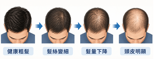 每天掉很多頭髮就是【雄性禿】？一次看懂這３個關鍵判斷！