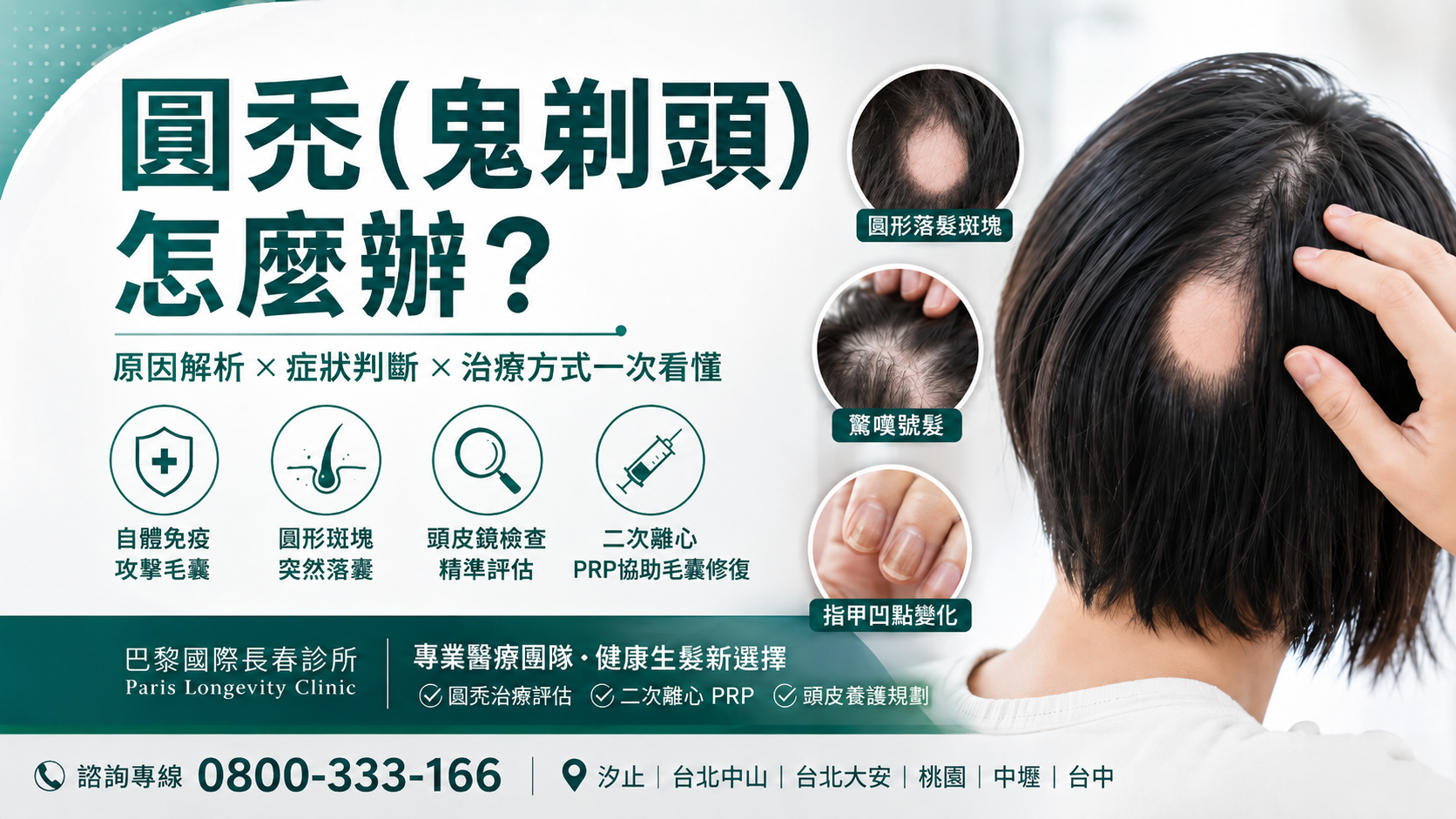 圓禿是什麼？鬼剃頭原因、症狀、恢復時間與治療方式整理