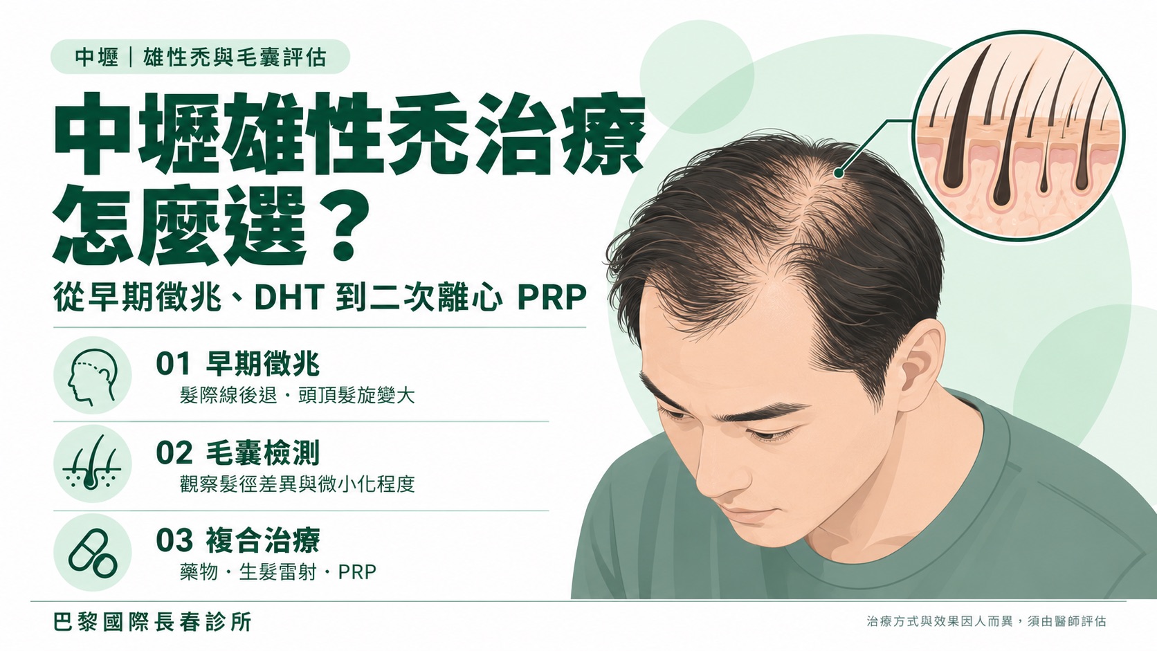 中壢雄性禿治療怎麼選?從早期徵兆、DHT到二次離心PRP一次看